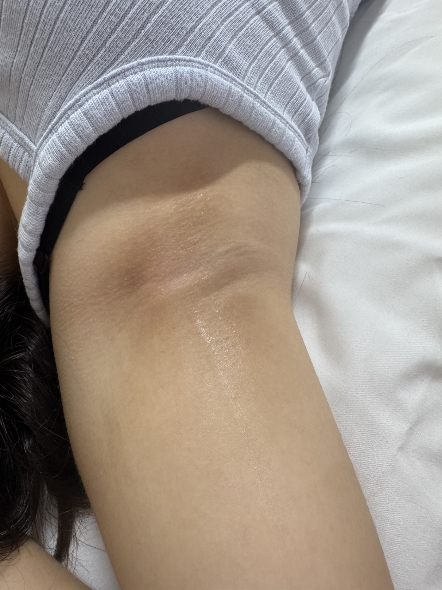 Facial treatment result 2 at Meraki Skin Solutions
