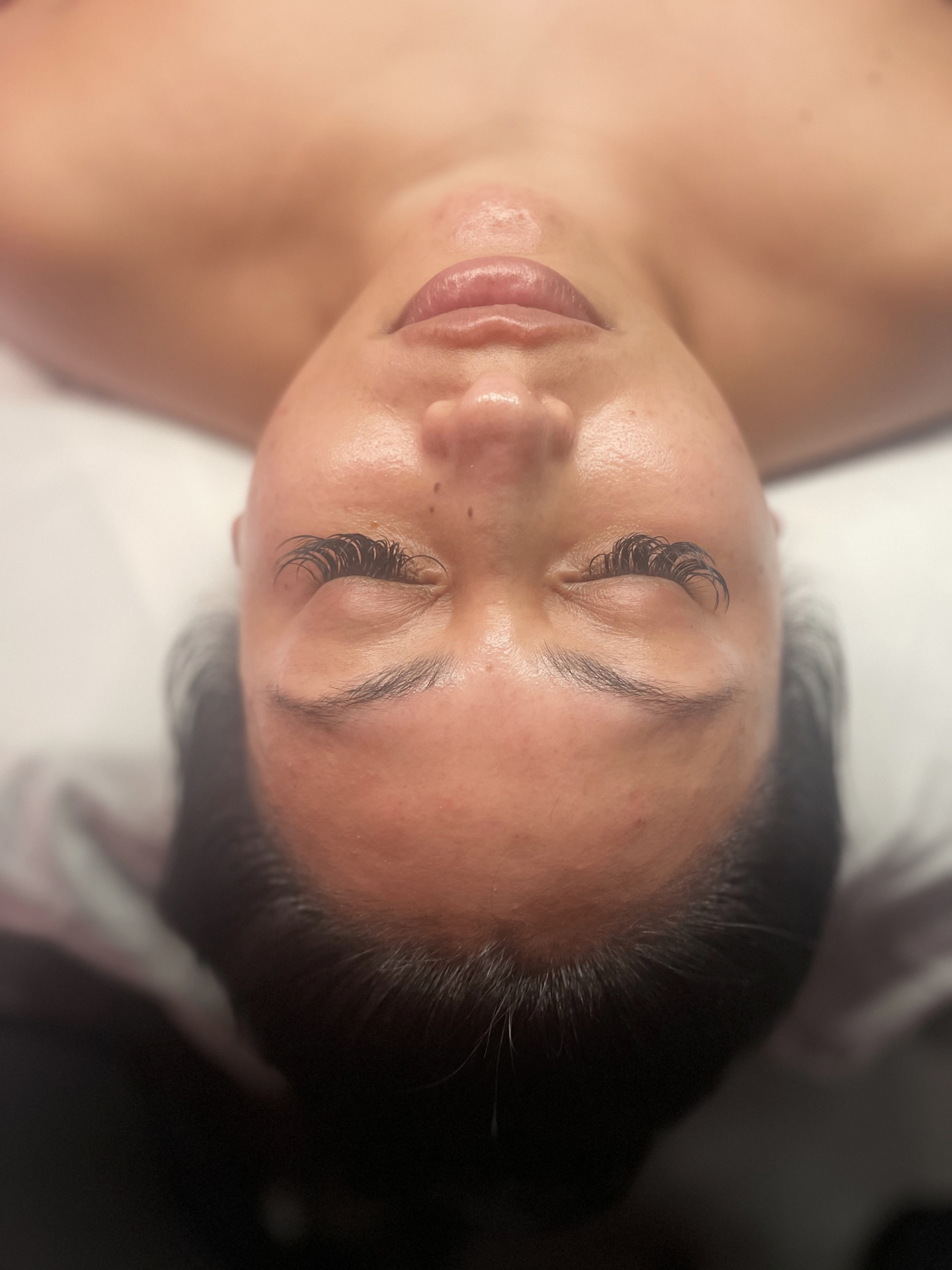 Facial treatment result 3 at Meraki Skin Solutions